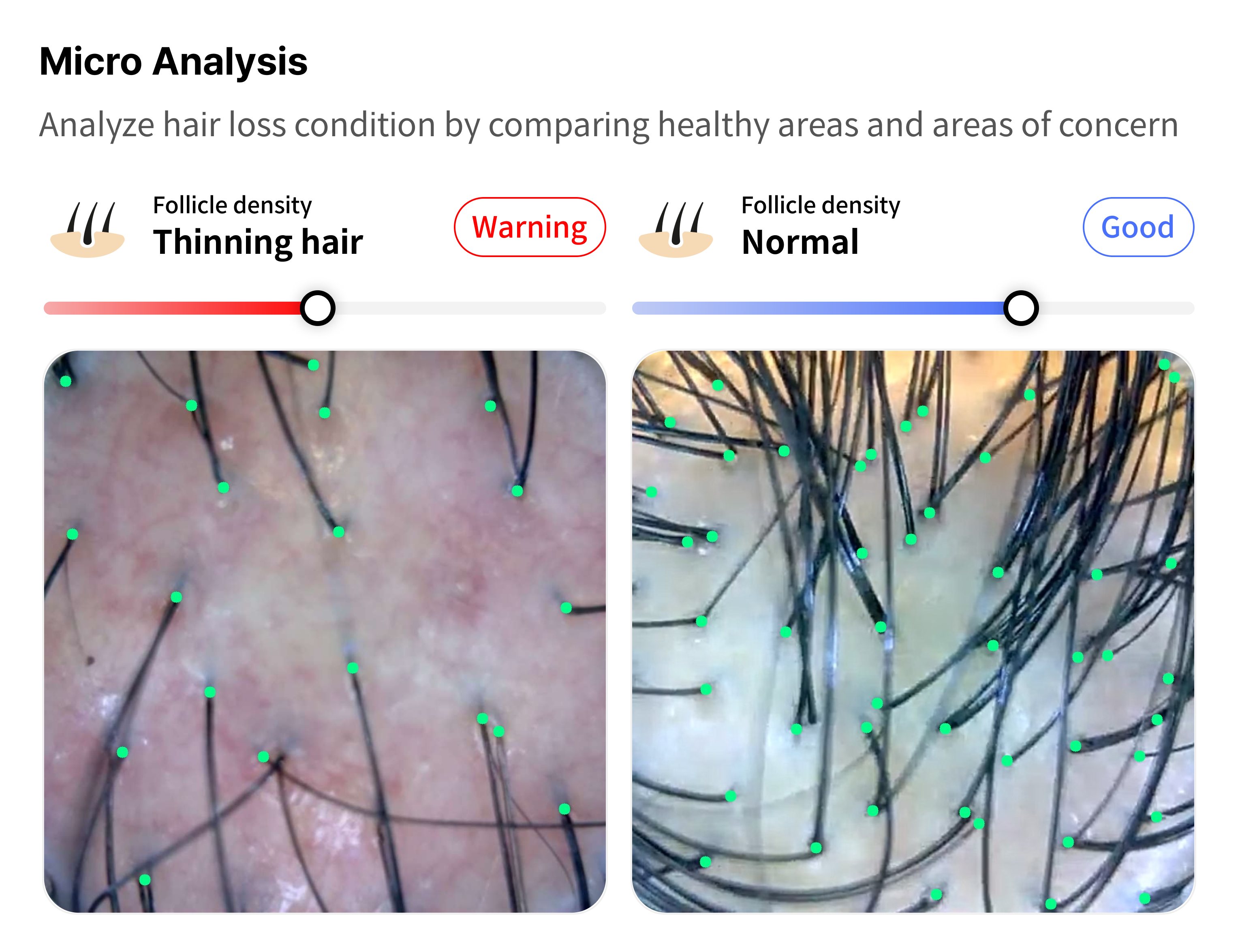 Scalp micro analysis — comparison of healthy vs concerned scalp