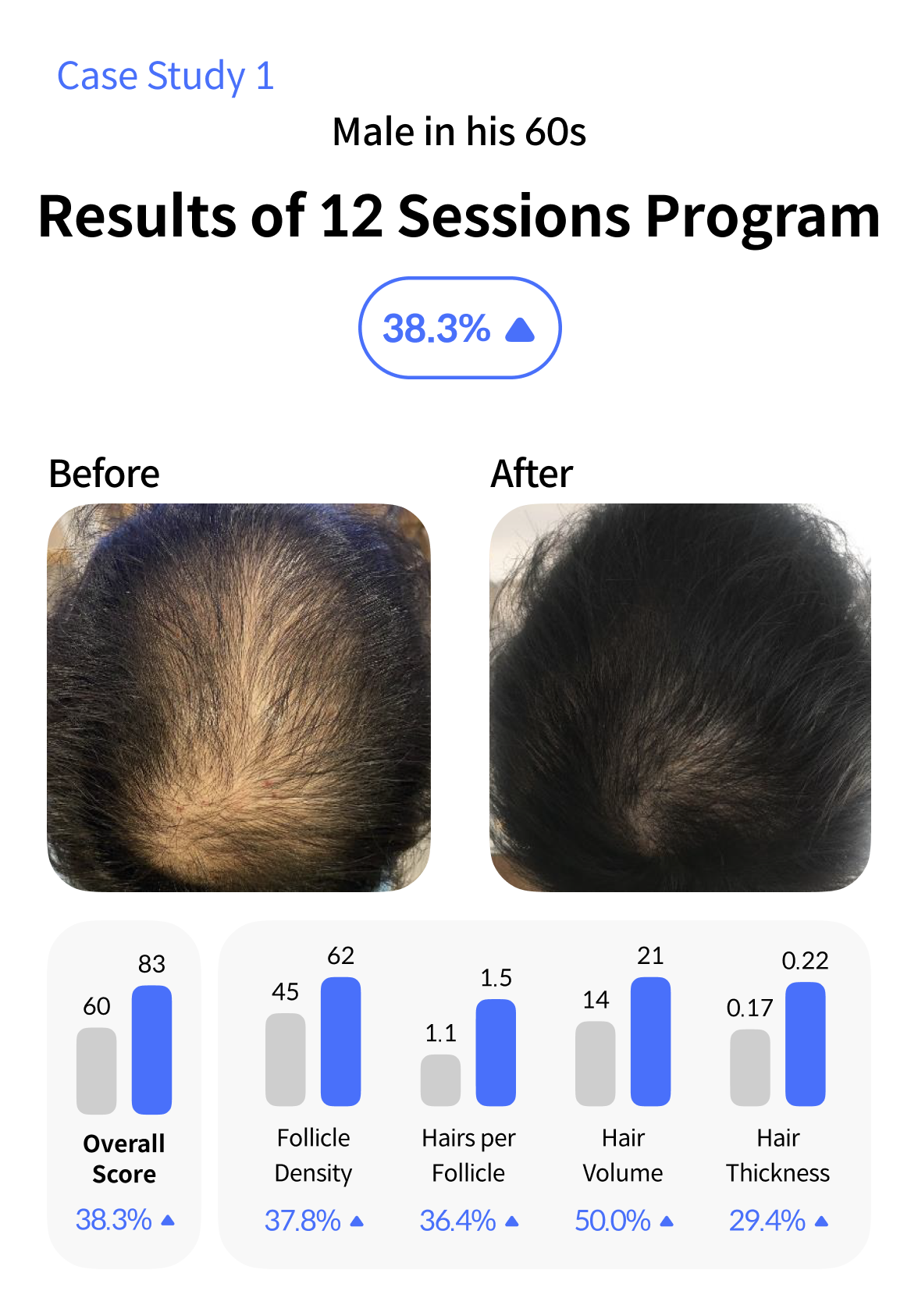 Hair Loss Treatment Case 1