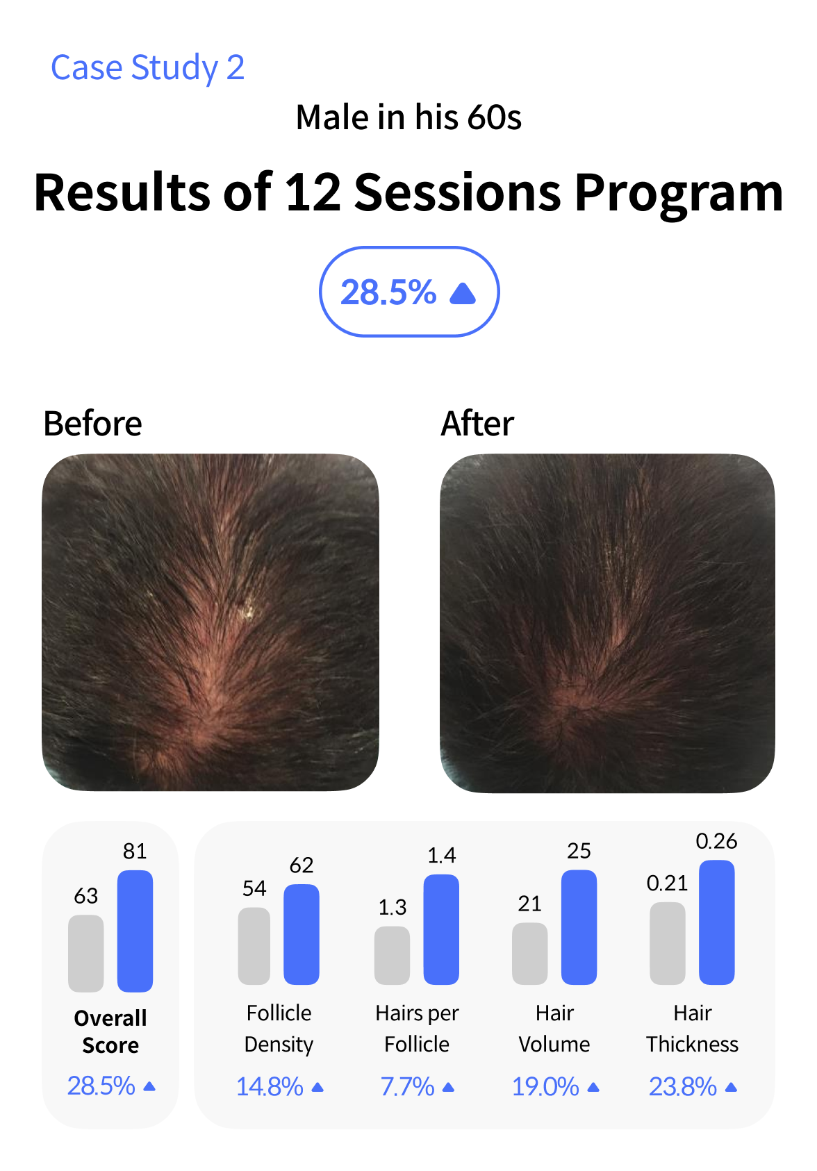 Hair Loss Treatment Case 2