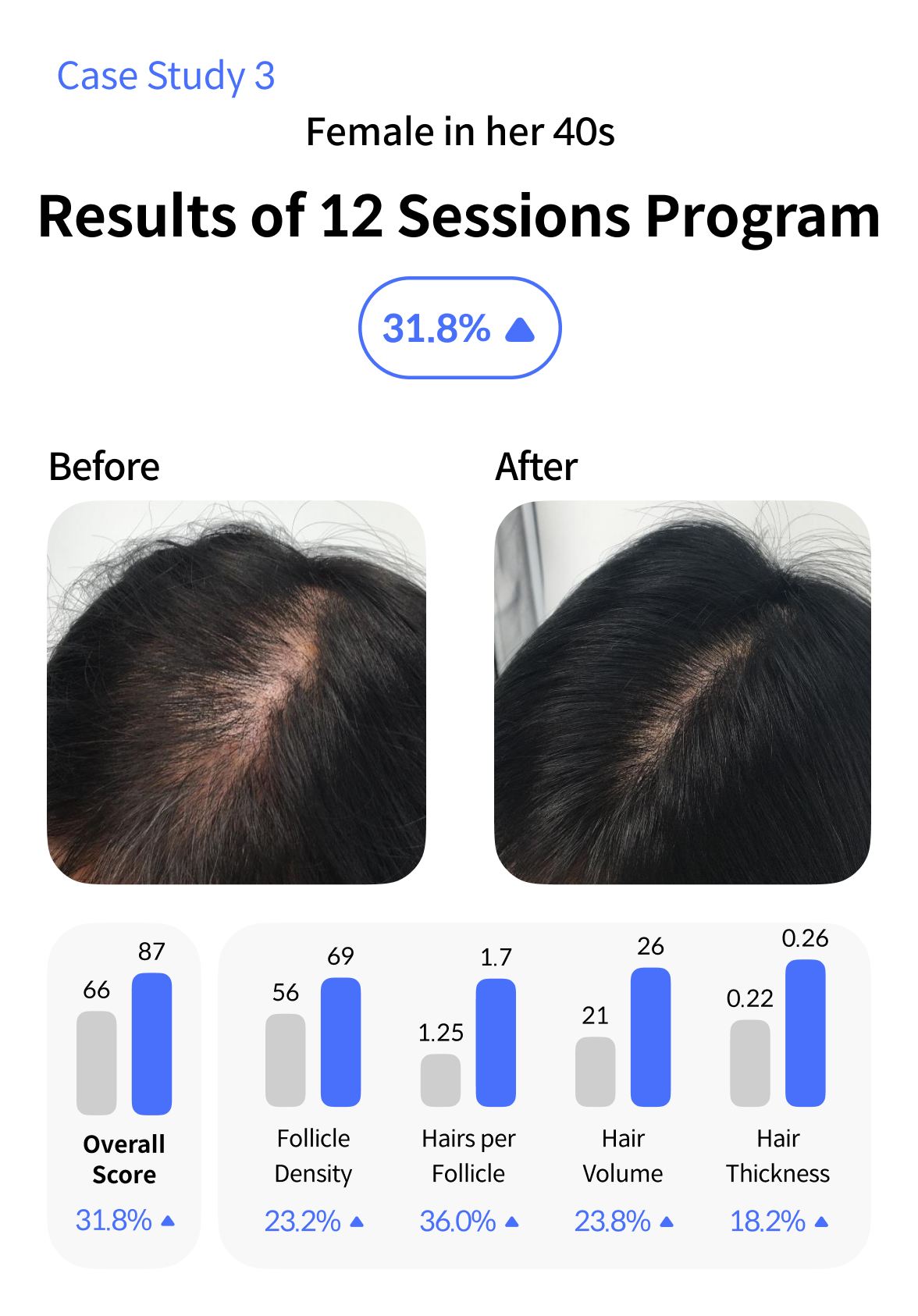 Crown-M Hair Loss Treatment