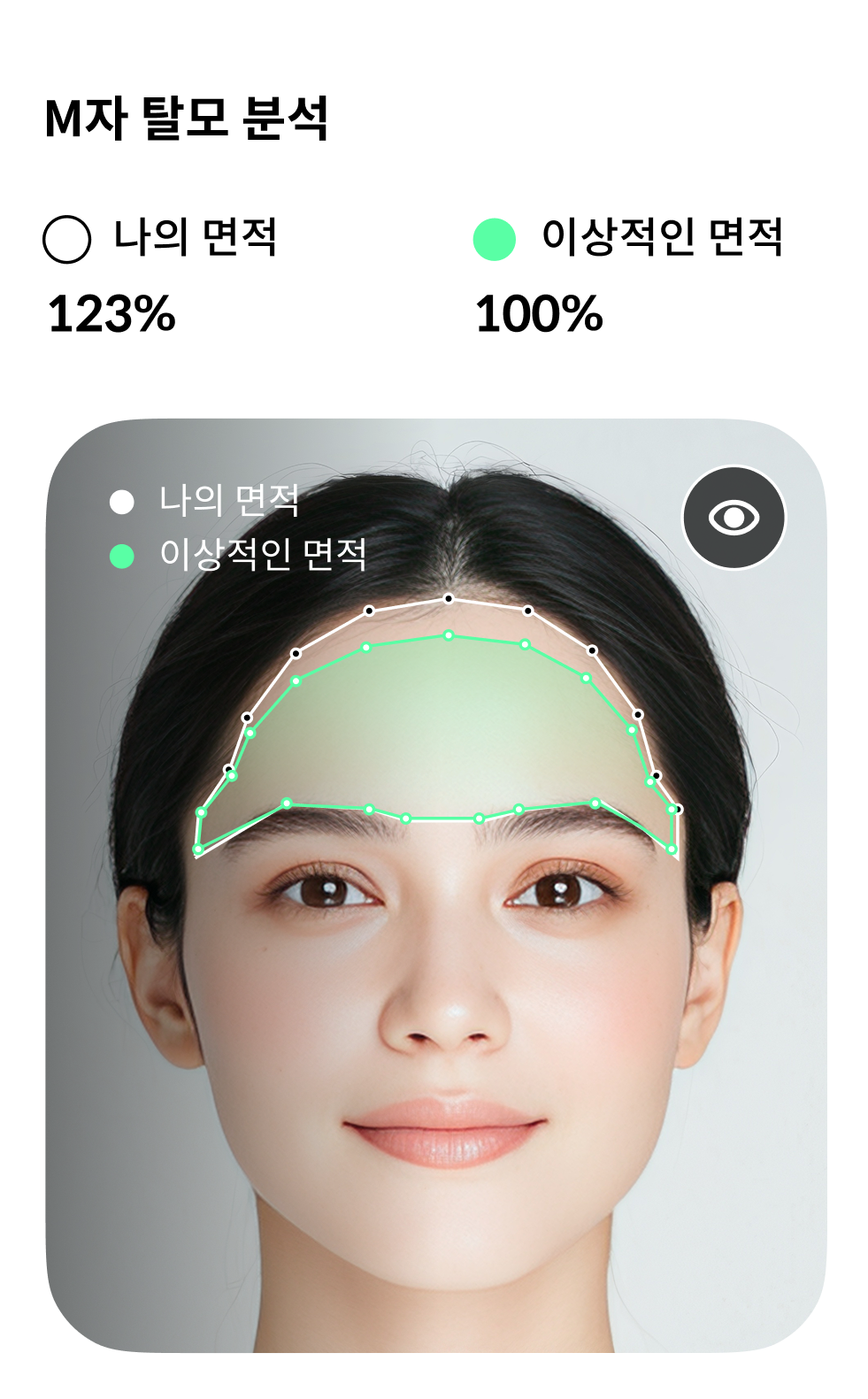 M-type hair loss camera analysis