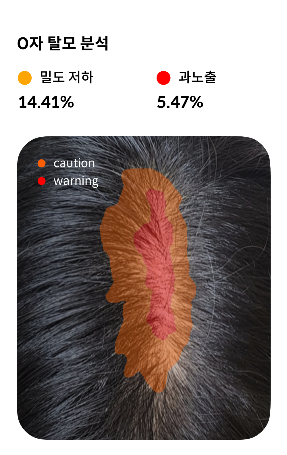 O-type hair loss camera analysis