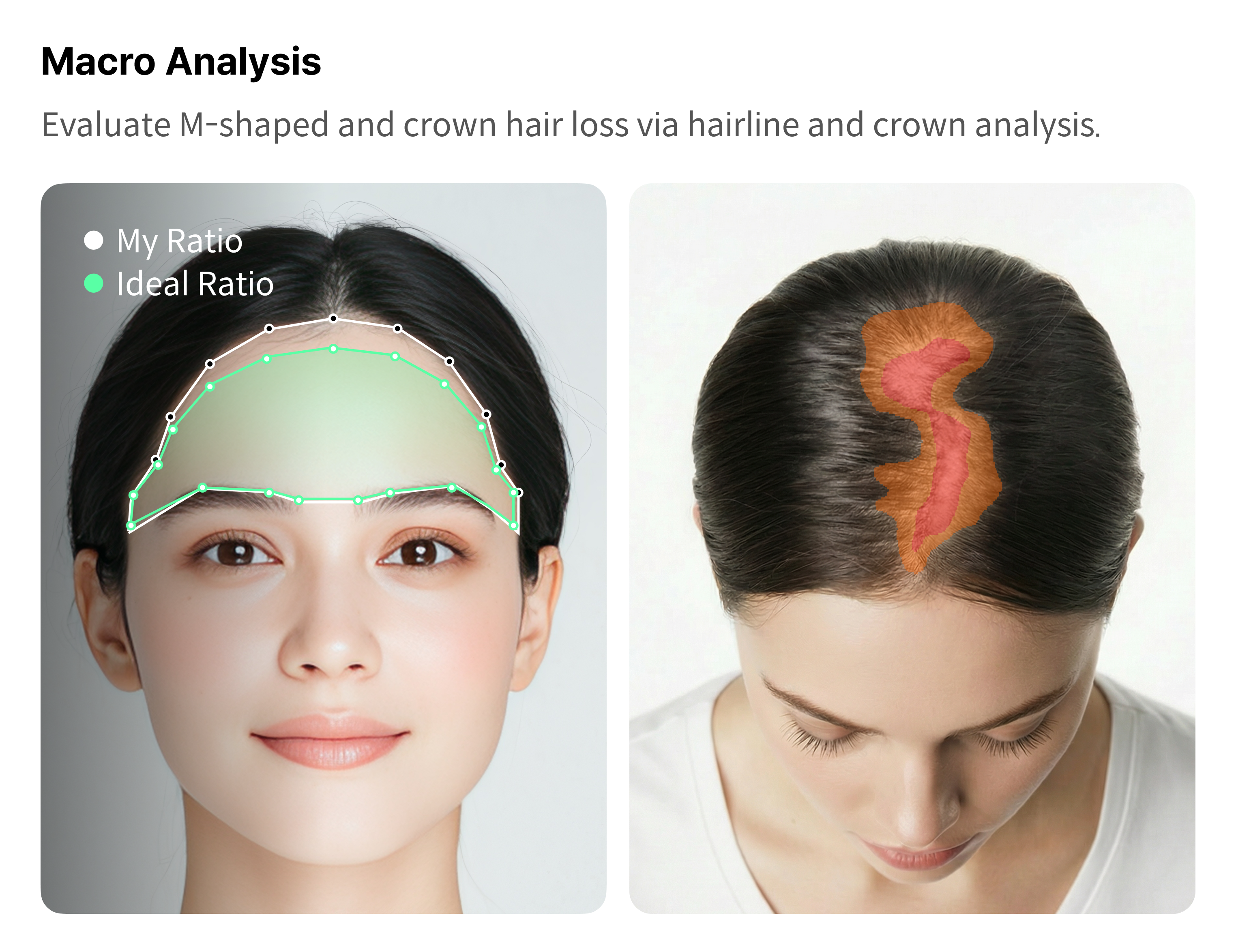 Hair loss macro analysis — hairline and crown