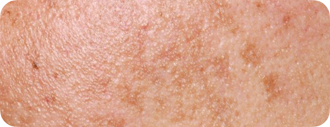 Skin tone & pigmentation changes